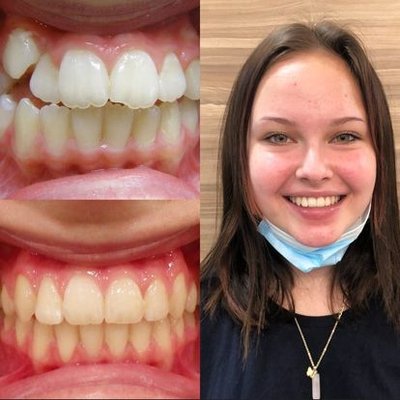 Before & After - At Wong Orthodontics, we love to create beautiful, healthy smiles using the newest, most efficient orthodontic treatments. We’re a community practice, serving the Covina, Upland, Glendora, and San Dimas communities for more than 47 years. Dr. Mark Wong and his knowledgeable team look forward to helping you achieve the smile you’ve always wanted!
We care, we listen, and we offer options!
Dr. Wong uses state-of-the-art braces and Invisalign to create wonderfully straight smiles for children, teens and adults.
Please feel free to contact our office to schedule your complimentary consultation with our friendly orthodontist and staff. Welcome to the Wong Orthodontics family! Before & After - At Wong Orthodontics, we love to create beautiful, healthy smiles using the newest, most efficient orthodontic treatments. We’re a community practice, serving the Covina, Upland, Glendora, and San Dimas communities for more than 47 years. Dr. Mark Wong and his knowledgeable team look forward to helping you achieve the smile you’ve always wanted!
We care, we listen, and we offer options!
Dr. Wong uses state-of-the-art braces and Invisalign to create wonderfully straight smiles for children, teens and adults.
Please feel free to contact our office to schedule your complimentary consultation with our friendly orthodontist and staff. Welcome to the Wong Orthodontics family!