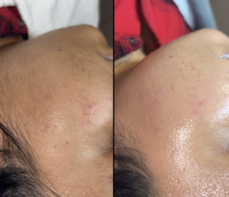 Dermaplaning - Using a medical grade scalpel, our skin experts perform an exfoliating treatment by removing the top layer of dead skin + peach fuzz! Removing this layer leaves your skin smooth and more prepare to absorb the skin care products you want to see results from.