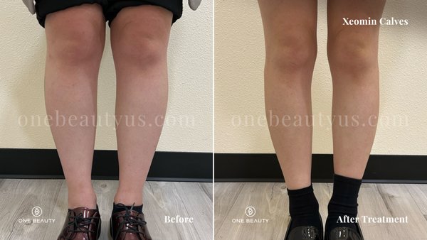 Calf Slimming - Calf slimming is a non-surgical procedure that uses toxin injections to temporarily weaken calf muscles and make them appear slimmer. It's a popular trend, nicknamed "calf tox". Calf Slimming - Calf slimming is a non-surgical procedure that uses toxin injections to temporarily weaken calf muscles and make them appear slimmer. It's a popular trend, nicknamed "calf tox".