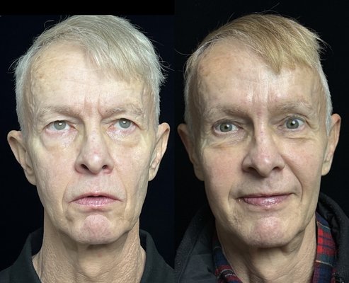 Sculptra for face and body - Sculptra generates collagen and increases volume naturally. Results are long lasting. Sculptra for face and body - Sculptra generates collagen and increases volume naturally. Results are long lasting.