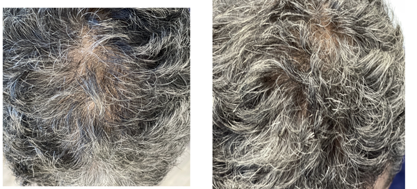 Hair Loss - Keralase - Hair loss treatments can varied. We love PRP and Keralase MD for best results.