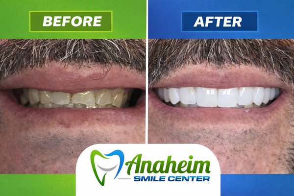 Before and After - Before and After pictures of cosmetic work, combination of crowns , veneers and implant crowns.