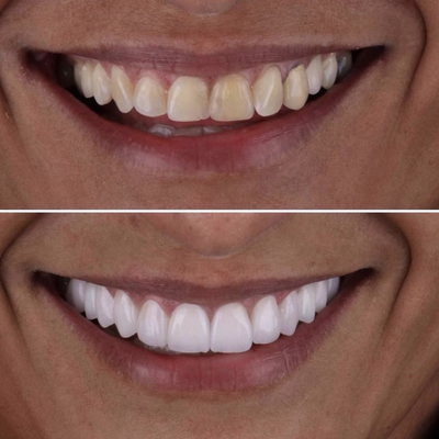 Teeth Whitening - Teeth Whitening Teeth Whitening - Teeth Whitening