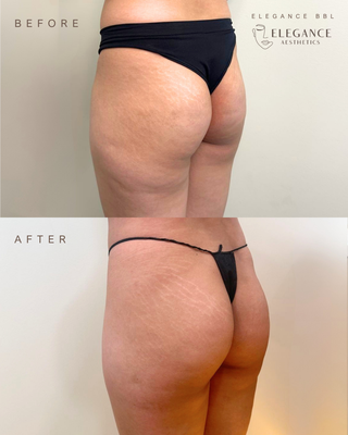 Non-Surgical BBL Before & After - The non-surgical bbl offered by Elegance Aesthetics Med Spa! See our before & after results.