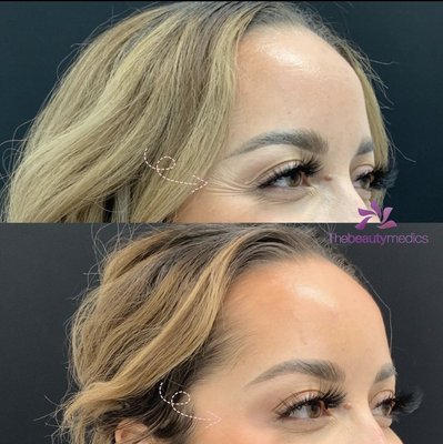 Botox/ Dysport - Botox/ Dysport injections are noted primarily for the ability to
reduce the appearance of facial wrinkles. In general,
Botox/ Dysport lasts 3-4 months. Botox/ Dysport - Botox/ Dysport injections are noted primarily for the ability to
reduce the appearance of facial wrinkles. In general,
Botox/ Dysport lasts 3-4 months.