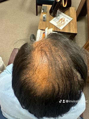 Hair replacement center - Invisahair Center is a leader in the provision of hair replacement systems and has the best solutions for men and women suffering from all forms of early to advanced stagesof hair loss. At Invisahair We provide non-surgical hair loss solution using the best and latest technology, which is called Invisagraft Hair Replacement systems and it is all about the natural hairlines look. Take the first step to replace, regrow and restore your hair today by calling us or book your free consutation in Our website.
