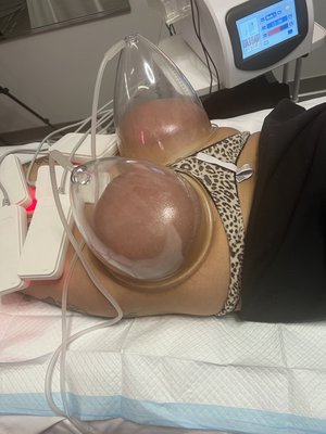 Non Invasion BBL + Body Contouring - Butt cupping can effectively tighten, tone, and enhance the buttocks in a way that looks subtle and natural. It achieves this by using suction technology to increase blood flow to the tissues and muscles in the buttocks. This effectively lifts the tissues and creates a more sculpted appearance.
In fact, one 30-minute butt cupping session has been shown to have the same effect as more than 1000 squats. Vacuum butt therapy can also smooth the skin, reducing the appearance of imperfections like cellulite.
The Benefits of Butt Cupping
Butt cupping procedures offer a number of aesthetic benefits, including the ones below:
Tightening the buttocks
Smoothing skin
Firming buttock tissue
Lifting the butt
Reducing the appearance of cellulite
Improving blood flow to the tissues and muscles
The biggest benefits of vacuum butt therapy are in the procedure itself. Butt cupping is an outpatient procedure that requires no recovery or downtime, allowing patients to resume their normal activities after treatment. Non Invasion BBL + Body Contouring - Butt cupping can effectively tighten, tone, and enhance the buttocks in a way that looks subtle and natural. It achieves this by using suction technology to increase blood flow to the tissues and muscles in the buttocks. This effectively lifts the tissues and creates a more sculpted appearance.
In fact, one 30-minute butt cupping session has been shown to have the same effect as more than 1000 squats. Vacuum butt therapy can also smooth the skin, reducing the appearance of imperfections like cellulite.
The Benefits of Butt Cupping
Butt cupping procedures offer a number of aesthetic benefits, including the ones below:
Tightening the buttocks
Smoothing skin
Firming buttock tissue
Lifting the butt
Reducing the appearance of cellulite
Improving blood flow to the tissues and muscles
The biggest benefits of vacuum butt therapy are in the procedure itself. Butt cupping is an outpatient procedure that requires no recovery or downtime, allowing patients to resume their normal activities after treatment.