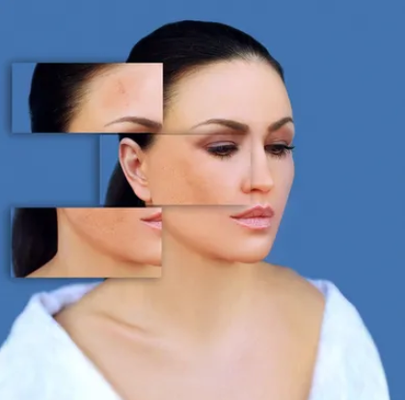 Chemical Peels - Consultation REQUIRED prior to booking this service.