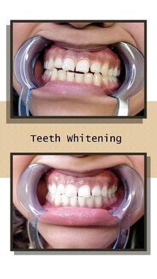 Teeth Whitening - Teeth will whiten as much as your natural teeth can no guarantee your teeth will be paper, cloud, cotton, egg shell, etc. white. Teeth Whitening - Teeth will whiten as much as your natural teeth can no guarantee your teeth will be paper, cloud, cotton, egg shell, etc. white.