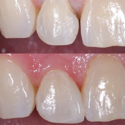 Cosmetic Bonding - Cosmetic Bonding – Instantly Transform Your Smile
Cosmetic bonding is a quick, painless, and cost-effective way to repair chips, close small gaps, reshape teeth, and improve overall appearance. Using a tooth-colored composite resin, we sculpt and blend the material seamlessly with your natural teeth — often in just one visit and without anesthesia.
This treatment is ideal for:
Repairing chipped or cracked teeth
Filling spaces between teeth
Reshaping uneven or worn edges
Covering small discolorations or spots
The results are immediate, natural-looking, and durable, helping you smile with confidence again. Cosmetic Bonding - Cosmetic Bonding – Instantly Transform Your Smile
Cosmetic bonding is a quick, painless, and cost-effective way to repair chips, close small gaps, reshape teeth, and improve overall appearance. Using a tooth-colored composite resin, we sculpt and blend the material seamlessly with your natural teeth — often in just one visit and without anesthesia.
This treatment is ideal for:
Repairing chipped or cracked teeth
Filling spaces between teeth
Reshaping uneven or worn edges
Covering small discolorations or spots
The results are immediate, natural-looking, and durable, helping you smile with confidence again.