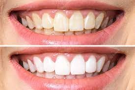Teeth whitening - Call now to hear about our monthly Specials Teeth whitening - Call now to hear about our monthly Specials