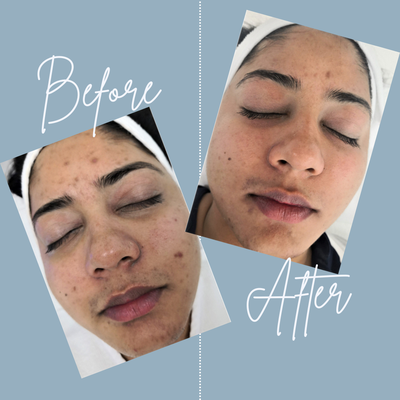 Before and After Photos - Amazing results at Radiance Wellness Med Spa Before and After Photos - Amazing results at Radiance Wellness Med Spa
