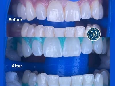 Teeth Whitening - Another great result at Sigma Dental Clinic, delivered by Dr. Sepi.
Our patient came in wanting a brighter, cleaner smile, and the results speak for themselves. With our professional teeth whitening treatment, he left with a noticeably whiter smile and renewed confidence. Teeth Whitening - Another great result at Sigma Dental Clinic, delivered by Dr. Sepi.
Our patient came in wanting a brighter, cleaner smile, and the results speak for themselves. With our professional teeth whitening treatment, he left with a noticeably whiter smile and renewed confidence.