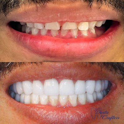 New Patients Specials - New Patients specials. All Dental Service Under One Roof.  +++ Invisalign.   Implants.  Crowns, Veneers.   Full Arch.  All in 6.   All in 4,  Full Mouth Make overs.   Root Canal.  Teeth Whitening.  Teeth Cleaning.   Hygiene Services.   Emergency Dental  services.  On Lays.