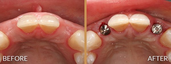 Dental Implants: Restore Your Complete Smile - Welcome to the Northridge Dental Group Dental Implants portfolio! For over 50 years, our multi-specialty practice has been helping patients in the San Fernando Valley reclaim their confidence, oral health, and quality of life. If you are missing one, several, or all of your teeth, our custom dental implant solutions provide a permanent, natural-looking, and fully functional replacement.
In this gallery, you'll see real results from our patients who have transformed their smiles. Because we are a comprehensive, multi-specialty practice, we handle every phase of your dental implant treatment entirely in-house. From precise surgical placement by our in-house oral surgeons and periodontists to the final, beautifully crafted custom crown by our cosmetic experts (like Dr. Shahdad Arami), you receive seamless care under one roof.
What sets our implants apart?
Premium Materials: We partner with industry-leading implant companies like Straumann, Nobel Biocare, and Zimmer Biomet Dental to ensure long-lasting, safe results.
Full-Mouth Restoration: We specialize in full-arch replacements, where just four precisely placed implants can securely support an entire top or bottom row of teeth.
Bone Health & Aesthetics: Our titanium implants fuse with your living bone, preventing future bone loss and maintaining a youthful facial structure.
Browse our before-and-after photos to see the Northridge Dental Group difference. When you are ready to eat, speak, and smile with confidence again, contact us to schedule your personalized dental implant consultation! Dental Implants: Restore Your Complete Smile - Welcome to the Northridge Dental Group Dental Implants portfolio! For over 50 years, our multi-specialty practice has been helping patients in the San Fernando Valley reclaim their confidence, oral health, and quality of life. If you are missing one, several, or all of your teeth, our custom dental implant solutions provide a permanent, natural-looking, and fully functional replacement.
In this gallery, you'll see real results from our patients who have transformed their smiles. Because we are a comprehensive, multi-specialty practice, we handle every phase of your dental implant treatment entirely in-house. From precise surgical placement by our in-house oral surgeons and periodontists to the final, beautifully crafted custom crown by our cosmetic experts (like Dr. Shahdad Arami), you receive seamless care under one roof.
What sets our implants apart?
Premium Materials: We partner with industry-leading implant companies like Straumann, Nobel Biocare, and Zimmer Biomet Dental to ensure long-lasting, safe results.
Full-Mouth Restoration: We specialize in full-arch replacements, where just four precisely placed implants can securely support an entire top or bottom row of teeth.
Bone Health & Aesthetics: Our titanium implants fuse with your living bone, preventing future bone loss and maintaining a youthful facial structure.
Browse our before-and-after photos to see the Northridge Dental Group difference. When you are ready to eat, speak, and smile with confidence again, contact us to schedule your personalized dental implant consultation!