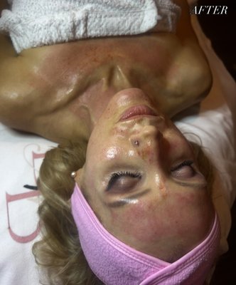 Facial - Signature Facial 
microneedling