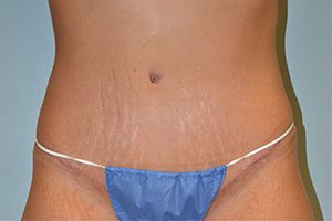 Extended Tummy Tuck - Extended abdominoplasty
Woman in her early 30s, mother of 4. Height: 5’9. Weight: 171lbs pre-op.
Post-op photos taken 2 months after surgery. Extended Tummy Tuck - Extended abdominoplasty
Woman in her early 30s, mother of 4. Height: 5’9. Weight: 171lbs pre-op.
Post-op photos taken 2 months after surgery.