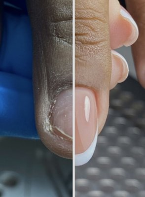 Gel C Extensions - Gel-X Extensions are also a healthy alternative to acrylics both for the person getting them, as well as the manicurist. While the FDA has repeatedly warned the public about how hazardous the chemicals in them can be many salon still offer them. The FDA has even banned some of the chemicals that can be found in acrylic nail solutions, such as methyl methacrylate, however, due to poor regulation in the nail industry, some salons still use products containing it as well. Other potentially toxic chemicals that can be found in acrylics include toluene and acetonitrile, both of which can cause skin irritation, respiratory issues, and in more serious cases, kidney and eye damage. Gel C Extensions - Gel-X Extensions are also a healthy alternative to acrylics both for the person getting them, as well as the manicurist. While the FDA has repeatedly warned the public about how hazardous the chemicals in them can be many salon still offer them. The FDA has even banned some of the chemicals that can be found in acrylic nail solutions, such as methyl methacrylate, however, due to poor regulation in the nail industry, some salons still use products containing it as well. Other potentially toxic chemicals that can be found in acrylics include toluene and acetonitrile, both of which can cause skin irritation, respiratory issues, and in more serious cases, kidney and eye damage.