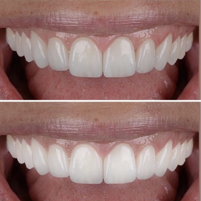 Teeth Whitening - Teeth Whitening cases at Fuller Smiles