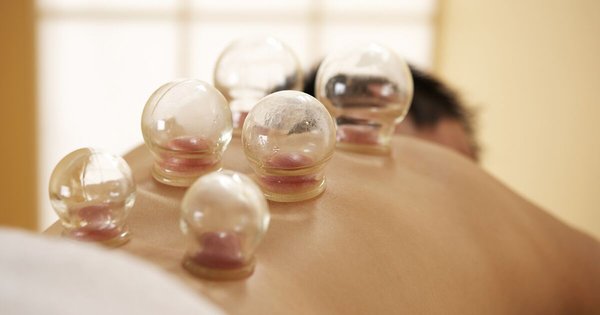 Cupping - Cupping therapy is an ancient form of alternative medicine in which a therapist puts special cups on your skin for a few minutes to create suction. People get it for many purposes, including to help with pain, inflammation, blood flow, relaxation and well-being, and as a type of deep-tissue massage. Cupping - Cupping therapy is an ancient form of alternative medicine in which a therapist puts special cups on your skin for a few minutes to create suction. People get it for many purposes, including to help with pain, inflammation, blood flow, relaxation and well-being, and as a type of deep-tissue massage.