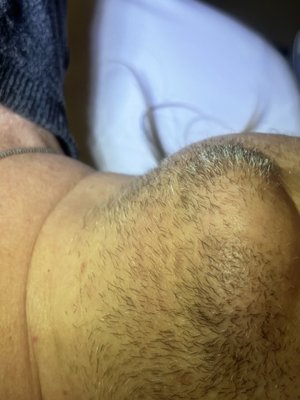 Permanent hair removal with electrolysis on chin - Meet our client who struggled with PCOS and unwanted chin hair. Every morning, she had to shave her chin, only to have noticeable stubble by evening.
But with electrolysis, the only permanent method of hair removal, we helped her get rid of that annoying hair for good. Now, she no longer needs to shave her face daily, doesn't battle ingrown hairs, and her confidence has soared. In her own words, "my life has changed."
Experience the difference with TS Electrolysis and change your life, too! Permanent hair removal with electrolysis on chin - Meet our client who struggled with PCOS and unwanted chin hair. Every morning, she had to shave her chin, only to have noticeable stubble by evening.
But with electrolysis, the only permanent method of hair removal, we helped her get rid of that annoying hair for good. Now, she no longer needs to shave her face daily, doesn't battle ingrown hairs, and her confidence has soared. In her own words, "my life has changed."
Experience the difference with TS Electrolysis and change your life, too!