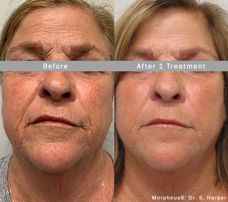 Morpheus8 Radiofrequency (RF) Microneedling - Minimally Invasive Facial & Body Fractional Remodeling - There is currently a promo on Morpheus8 for 3 sessions of full face, neck, under chin fat reduction & buccal fat reduction for $3000 (valued at over $9000)!
Morpheus8 is a minimally invasive modular RF fractional solution for full body subdermal adipose remodeling. It combines radio-frequency with the microneedling technique making it the most advanced form of microneedling. On its own, microneedling provokes a healing response in which collagen production increases. With Morpheus8, collagen increase is only part of the benefits. By inserting radio-frequency energy directly to tissue a few millimeters deep, this device prompts tissue remodeling that includes thickening and tightening. It is an excellent device to help minimize signs of aging as well as prevent it! It is also great for fat reduction in areas like under the chin, jowls, above the knees, thighs etc. There is currently a promo on Morpheus8 for 3 sessions of full face, neck, under chin fat reduction & buccal fat reduction for $3000 (valued at over $9000)! Morpheus8 Radiofrequency (RF) Microneedling - Minimally Invasive Facial & Body Fractional Remodeling - There is currently a promo on Morpheus8 for 3 sessions of full face, neck, under chin fat reduction & buccal fat reduction for $3000 (valued at over $9000)!
Morpheus8 is a minimally invasive modular RF fractional solution for full body subdermal adipose remodeling. It combines radio-frequency with the microneedling technique making it the most advanced form of microneedling. On its own, microneedling provokes a healing response in which collagen production increases. With Morpheus8, collagen increase is only part of the benefits. By inserting radio-frequency energy directly to tissue a few millimeters deep, this device prompts tissue remodeling that includes thickening and tightening. It is an excellent device to help minimize signs of aging as well as prevent it! It is also great for fat reduction in areas like under the chin, jowls, above the knees, thighs etc. There is currently a promo on Morpheus8 for 3 sessions of full face, neck, under chin fat reduction & buccal fat reduction for $3000 (valued at over $9000)!