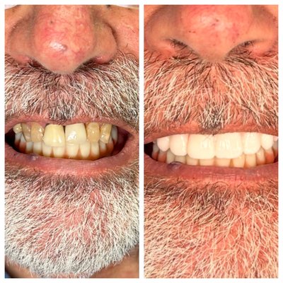 SAME DAY SMILE MAKEOVERS - "A brand new smile — in just ONE day. 😲🦷"
Yes, it’s possible at Avion Dental in Chino Hills, CA.

✅ No waiting months
✅ No removable dentures
✅ Full-arch dental implants — placed SAME DAY

Our advanced tech + in-house lab makes it all happen faster, safer, and more comfortably than ever.

🛑 Stop hiding your smile.
Start living confidently — TODAY.

📍Chino Hills, CA
📞 Call now or click the link in bio to schedule your free consultation with Dr. Kim!

#SameDayImplants #DentalImplantsChinoHills #ChinoHillsDentist #AvionDental #FullArchImplants #SmileMakeover #TeethInADay #ChinoHillsSmiles #ImplantDentistNearMe #ChinoHillsCA #AllOn4 #ImplantTransformation #SmileGoals