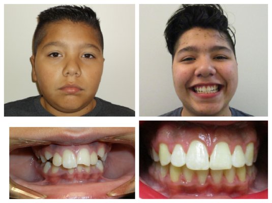 Braces Treatment - Patients were treated with braces by Dr Beroukhim DDS, Board Certified Orthodontist. Braces Treatment - Patients were treated with braces by Dr Beroukhim DDS, Board Certified Orthodontist.