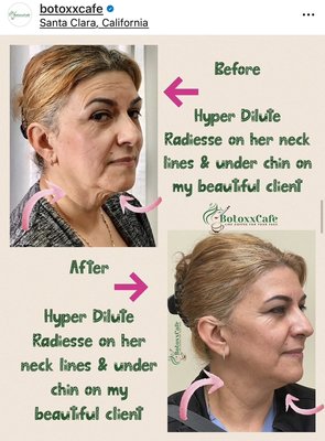 Derma Fillers - How Dermal Fillers Work?
Dermal fillers are used to restore volume and soften folds, lines and wrinkles around your mid and lower face.

Fillers, (Hyaluronic acid) can be used to treat wrinkles and depressions in the temporal area, cheeks, jaws, jawlines, nasolabial folds, chin and it is the best used for lips contouring and enhancement, smile lines, marionette lines can all be treated by our skilled nurse injector. We use Allergan fillers that are first products to be approved by the FDA for aesthetic use. The effect is to plump up your unwanted folds and wrinkles, reducing their prominence and resulting in a smoother, more youthful, rejuvenated skin.

Dermal fillers can also be used to restore volume and augment the cheek bones or temple area. By giving more lift in these areas, you can lift other lines, such as marionette lines.

Dermal fillers rejuvenate and restore your skin?
The most commonly used dermal fillers are based on a chemical which occurs naturally in humans. In its treatment form, it is a gel-like solution which is injected into the skin.

Dermal fillers anti-ageing treatments will usually last around six months to a year, before the effect becomes less noticeable, and a top up treatment is required.  And, with repeated treatments, the effects can often last longer.

After your personal consultation with Nurse Mehta, she will develop a personalized treatment plan for you. 

O