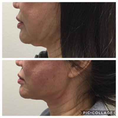 Wake Up Beautiful Thread Lift - The Wake Up Beautiful Thread Lift helps patients experience instant benefits of a facelift, without any surgery. There are no cuts, stitches, or general anesthesia used in Thread Lifts. Injections are used in areas of the face, neck, or body to insert medical-grade PDO threads under the skin. These threads act to lift and tighten the desired area. The body's natural healing response increases collagen production, helping with anti-aging and a rejuvenating appearance. The threads naturally dissolve over time. Many of our Thread Lift patients report the results getting better as time goes on! Wake Up Beautiful Thread Lift - The Wake Up Beautiful Thread Lift helps patients experience instant benefits of a facelift, without any surgery. There are no cuts, stitches, or general anesthesia used in Thread Lifts. Injections are used in areas of the face, neck, or body to insert medical-grade PDO threads under the skin. These threads act to lift and tighten the desired area. The body's natural healing response increases collagen production, helping with anti-aging and a rejuvenating appearance. The threads naturally dissolve over time. Many of our Thread Lift patients report the results getting better as time goes on!