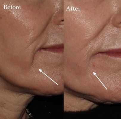 Dermal Fillers - Dermal Fillers can be used to address multiple parts of the face. Dermal Fillers - Dermal Fillers can be used to address multiple parts of the face.