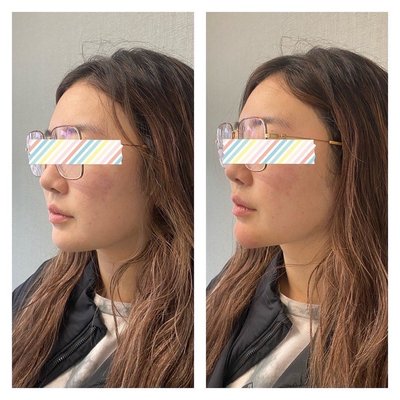 Jawline Contouring - Jawline contouring is an advanced technique to chisel the jawline and chin with dermal filler. Jawline Contouring - Jawline contouring is an advanced technique to chisel the jawline and chin with dermal filler.