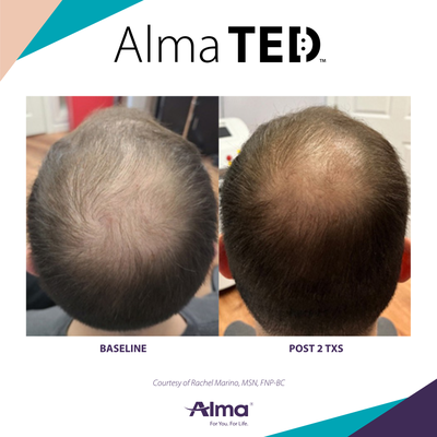 Alma Ted- Hair Restoration - Alma TED™ Hair Restoration
Restore fuller, healthier-looking hair—without needles, pain, or downtime.
Alma TED™ is an advanced, non-invasive hair restoration treatment designed for both men and women experiencing hair thinning or hair loss. Using ultrasound technology and air pressure, it delivers a powerful proprietary hair growth serum deep into the scalp, where it nourishes hair follicles and supports healthier, thicker hair growth.
This comfortable treatment helps:
Stimulate natural hair growth
Increase hair density and thickness
Reduce hair shedding
Improve scalp health
Support stronger, healthier hair over time
Unlike traditional hair restoration treatments, Alma TED™ requires no needles, no injections, and no downtime, making it an excellent option for guests looking for an effective, comfortable solution.
Best for:
Thinning hair
Early-stage hair loss
Postpartum hair thinning
Age- or hormone-related hair loss
Men and women seeking fuller, healthier hair
Results are progressive, with a series of treatments recommended for optimal improvement. A personalized consultation will help determine the best treatment plan for your hair restoration goals.
Healthy hair starts at the scalp. Let Alma TED™ help you regain confidence—one follicle at a time. Alma Ted- Hair Restoration - Alma TED™ Hair Restoration
Restore fuller, healthier-looking hair—without needles, pain, or downtime.
Alma TED™ is an advanced, non-invasive hair restoration treatment designed for both men and women experiencing hair thinning or hair loss. Using ultrasound technology and air pressure, it delivers a powerful proprietary hair growth serum deep into the scalp, where it nourishes hair follicles and supports healthier, thicker hair growth.
This comfortable treatment helps:
Stimulate natural hair growth
Increase hair density and thickness
Reduce hair shedding
Improve scalp health
Support stronger, healthier hair over time
Unlike traditional hair restoration treatments, Alma TED™ requires no needles, no injections, and no downtime, making it an excellent option for guests looking for an effective, comfortable solution.
Best for:
Thinning hair
Early-stage hair loss
Postpartum hair thinning
Age- or hormone-related hair loss
Men and women seeking fuller, healthier hair
Results are progressive, with a series of treatments recommended for optimal improvement. A personalized consultation will help determine the best treatment plan for your hair restoration goals.
Healthy hair starts at the scalp. Let Alma TED™ help you regain confidence—one follicle at a time.