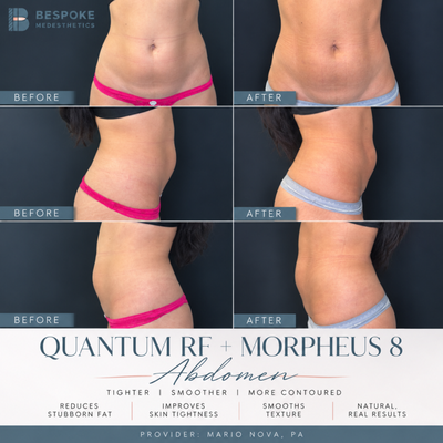 QuantumRF + Morpheus8 abdomen treatment at Bespoke Medesthetics in Jericho, NY - QuantumRF + Morpheus8 abdomen treatment at Bespoke Medesthetics in Jericho, NY helps tighten loose skin, improve definition, and contour the midsection. This advanced combination uses radiofrequency energy and RF microneedling to target skin laxity and stimulate collagen for a firmer, smoother appearance without traditional surgery.
Ideal for patients experiencing abdominal skin laxity after weight loss, pregnancy, or aging who want improved contour and skin quality. Serving Jericho, Nassau County, and Long Island, NY. QuantumRF + Morpheus8 abdomen treatment at Bespoke Medesthetics in Jericho, NY - QuantumRF + Morpheus8 abdomen treatment at Bespoke Medesthetics in Jericho, NY helps tighten loose skin, improve definition, and contour the midsection. This advanced combination uses radiofrequency energy and RF microneedling to target skin laxity and stimulate collagen for a firmer, smoother appearance without traditional surgery.
Ideal for patients experiencing abdominal skin laxity after weight loss, pregnancy, or aging who want improved contour and skin quality. Serving Jericho, Nassau County, and Long Island, NY.