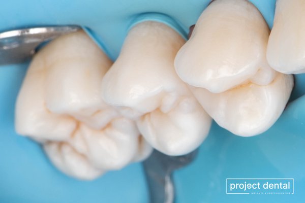 Dental Fillings - One of the common ways to fix your cavity is using composite resin restorations. Modern composite resins can provide excellent aesthetic outcomes and durability. However, the success of the composite resin restorations depends heavily on proper bonding methods which can be very technique sensitive. At Project Dental, we utilize various isolation methods to properly bond the restoration so that it lasts a very long time for the patient. Dental Fillings - One of the common ways to fix your cavity is using composite resin restorations. Modern composite resins can provide excellent aesthetic outcomes and durability. However, the success of the composite resin restorations depends heavily on proper bonding methods which can be very technique sensitive. At Project Dental, we utilize various isolation methods to properly bond the restoration so that it lasts a very long time for the patient.