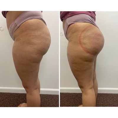 Brazilian Butt Lift - This folder contains examples we have operated on for Brazilian Butt Lifts Brazilian Butt Lift - This folder contains examples we have operated on for Brazilian Butt Lifts