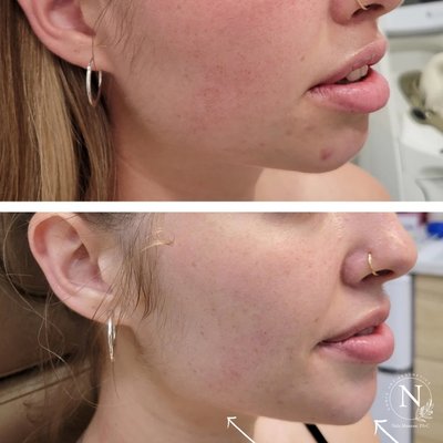 Snatch your jawline - Snatch your jawline with filler for your chin and Botox to shrink the masseter muscles. Natural, minimally invasive treatment and results. Snatch your jawline - Snatch your jawline with filler for your chin and Botox to shrink the masseter muscles. Natural, minimally invasive treatment and results.