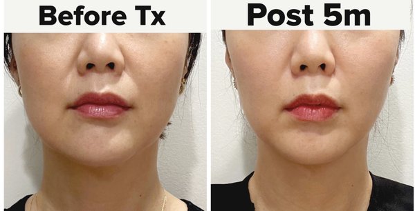 Non-surgical facelift - This patient wanted to achieve overall face shaping as well as improving her texture. While she was waiting for her results to kick in from Ultherapy, she also added on collagen volume injections to increase volume to her smile line, and her cheeks.
Extremely great results without dramatic over-changed appearance was the patient and our top goal while creating her treatment plan.