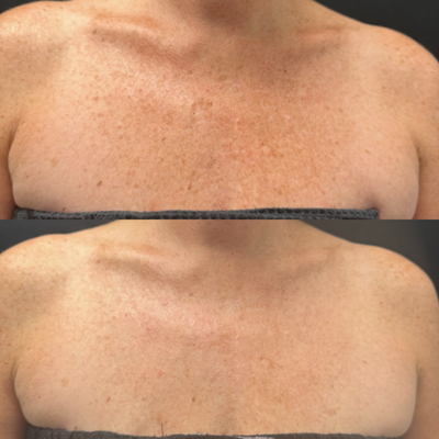 IPL Photofacial Results - Intense Pulsed Light (IPL), or photofacial, is a non-invasive cosmetic treatment that uses broad-spectrum light to target various skin issues. IPL is commonly used for treating pigmentation, sun damage, acne scars, and vascular lesions. IPL Photofacial Results - Intense Pulsed Light (IPL), or photofacial, is a non-invasive cosmetic treatment that uses broad-spectrum light to target various skin issues. IPL is commonly used for treating pigmentation, sun damage, acne scars, and vascular lesions.