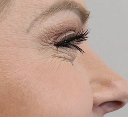 Botox Before & After - Daxxify® is the newest generation of neuromodulator treatment designed to smooth fine lines and wrinkles with results that last longer than traditional Botox. Like Botox, Daxxify® works by temporarily relaxing targeted facial muscles to reduce the appearance of frown lines, forehead wrinkles, and crow’s feet—leaving you with a refreshed, youthful look.
What sets Daxxify® apart is its advanced peptide technology, which allows results to last up to 6 months or more for many patients—about twice as long as standard Botox. This means fewer appointments and longer-lasting confidence. The treatment is quick, minimally invasive, and requires little to no downtime, making it easy to fit into your lifestyle.
Whether you’re new to wrinkle relaxers or looking for a longer-lasting option, Daxxify® offers a safe and effective solution for natural, rejuvenated results. Botox Before & After - Daxxify® is the newest generation of neuromodulator treatment designed to smooth fine lines and wrinkles with results that last longer than traditional Botox. Like Botox, Daxxify® works by temporarily relaxing targeted facial muscles to reduce the appearance of frown lines, forehead wrinkles, and crow’s feet—leaving you with a refreshed, youthful look.
What sets Daxxify® apart is its advanced peptide technology, which allows results to last up to 6 months or more for many patients—about twice as long as standard Botox. This means fewer appointments and longer-lasting confidence. The treatment is quick, minimally invasive, and requires little to no downtime, making it easy to fit into your lifestyle.
Whether you’re new to wrinkle relaxers or looking for a longer-lasting option, Daxxify® offers a safe and effective solution for natural, rejuvenated results.