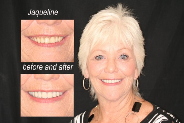 Natural looking FULL DENTURES - Full dentures to replace missing, decayed, hopeless teeth.