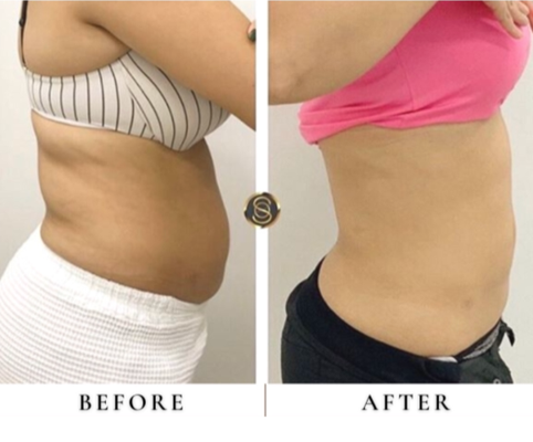 Fat Freeze - Soul Body Studio is dedicated to sculpting the body you’ve always wanted. We will reduce fat in unwanted areas, tone and define your body and face. Our non-surgical, low-level laser procedures are proven to safely shrink fat cells in any area you choose to target. Allowing you to tone, define, and sculpt your waist, thighs, calves and stomach. We also specialize in reducing the appearance of cellulite. Our method is painless and requires no surgery, no downtime and is a much safer and healthier alternative.
Call us today for a free consultation! Fat Freeze - Soul Body Studio is dedicated to sculpting the body you’ve always wanted. We will reduce fat in unwanted areas, tone and define your body and face. Our non-surgical, low-level laser procedures are proven to safely shrink fat cells in any area you choose to target. Allowing you to tone, define, and sculpt your waist, thighs, calves and stomach. We also specialize in reducing the appearance of cellulite. Our method is painless and requires no surgery, no downtime and is a much safer and healthier alternative.
Call us today for a free consultation!