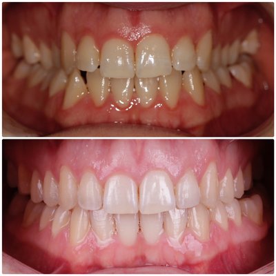 Invisalign - Invisalign clear aligners do more than just straighten teeth - they improve how your teeth fit together (occlusion), enhancing both function and long-term oral health. Whether you are dealing with crowding, spacing, or a misaligned bite, Invisalign offers a comfortable and nearly invisible solution that gradually shifts your teeth into a healthier, more balanced position. Not only does this improve your ability to chew and speak properly, but it also elevates the overall aesthetics of your smile - and that is what we specialize in at our office. Many of our patients love how Invisalign gives them the confidence of a beautiful smile while also supporting the health an dfunction of their teeth and jaws. Practicing Invisalign since 2012, Dr. Oh has more that 10 years of experience designing the most beautiful smiles to fit your face. Whether it be your first time straightening your teeth as an adult or like most people, wanting to get your teeth back to shape after a lapse in not wearing your retainers since high school - we are here to help you achieve the best smile you deserve. Call our office today and book an appointment for a complimentary consultation! Invisalign - Invisalign clear aligners do more than just straighten teeth - they improve how your teeth fit together (occlusion), enhancing both function and long-term oral health. Whether you are dealing with crowding, spacing, or a misaligned bite, Invisalign offers a comfortable and nearly invisible solution that gradually shifts your teeth into a healthier, more balanced position. Not only does this improve your ability to chew and speak properly, but it also elevates the overall aesthetics of your smile - and that is what we specialize in at our office. Many of our patients love how Invisalign gives them the confidence of a beautiful smile while also supporting the health an dfunction of their teeth and jaws. Practicing Invisalign since 2012, Dr. Oh has more that 10 years of experience designing the most beautiful smiles to fit your face. Whether it be your first time straightening your teeth as an adult or like most people, wanting to get your teeth back to shape after a lapse in not wearing your retainers since high school - we are here to help you achieve the best smile you deserve. Call our office today and book an appointment for a complimentary consultation!