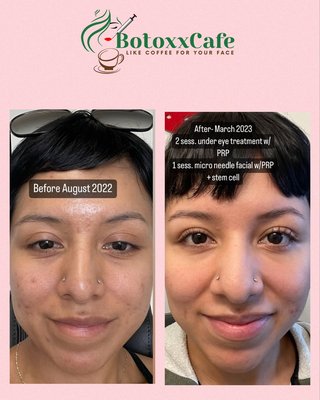 Skin Rejuvenation - What is Facial Rejuvenation?
Laser creates results, thanks to the revolutionary ablative and non-ablative waves that target both surface and deep wrinkles. This creates phenomenal elasticity and volume in the skin, 

The combination of Halo & PRP offers maximum results, delivering the instant impact of Halo treatments, with the rejuvenating, long term benefits of PRP, which is why it’s quickly becoming one of the most popular treatment combinations out there! If you’re looking for instant results that last. 

How does Facial Rejuvenation work?
The Sciton Halo™ is another fractional laser that can be used in conjunction with PRP to create glowing results. The Halo™ laser uses ablative and nonlative wavelengths to treat both the dermis and epidermis to reduce the appearance of sun damage and uneven skin tone.

Read more about laser & PRP for facial rejuvenation:

http://www.apieceofelise.com/bye-bye-makeup-vampire-facial-prp-halo-laser-at-visage-clinic/