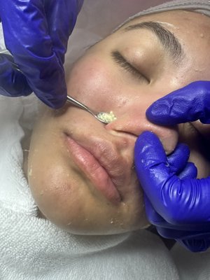 Our facial extraction and blackheads removal - Ishine Be gone facial extraction 
No pain, wont leave any scar marks, leave skin super clean and glowing