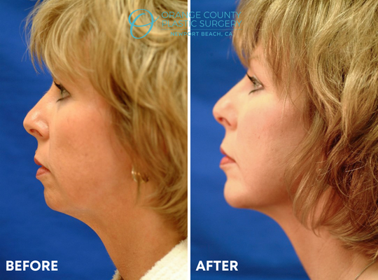 Chin Augmentation - Chin implants/augmentation can significantly improve profile view