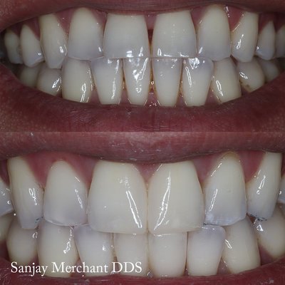 Cosmetic Dentistry - KOR Whitening and Cosmetic Bonding are some of the conservative and non-invasive ways to improve your smile! Cosmetic Dentistry - KOR Whitening and Cosmetic Bonding are some of the conservative and non-invasive ways to improve your smile!