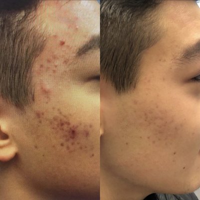 Acne Treatment - SINY Dermatology's board-certified dermatologists can create customized acne treatments to treat even the most severe cases of acne. Acne Treatment - SINY Dermatology's board-certified dermatologists can create customized acne treatments to treat even the most severe cases of acne.