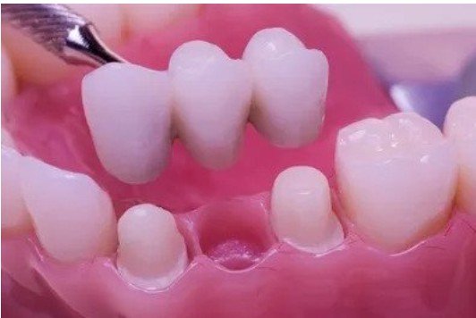 DENTAL BRIDGES - If you are a patient that has experienced tooth loss, then dental bridges may be the perfect solution for you. A bridge is used to replace a lost or completely broken tooth if a denture or dental implant is not placed or is not an option. The false tooth, also known as a pontic, is fused between two dental crowns giving it the bridge concept. The two dental crowns holding it in place are attached to your natural teeth on each side.
Dental bridges are made with all porcelain, making the results of this procedure very cosmetically appealing. Fixed bridges cannot be taken out of the mouth as you might do with a traditional denture making it less of a hassle for you in your daily maintenance and oral health routines.
Missing tooth? Make an appointment today DENTAL BRIDGES - If you are a patient that has experienced tooth loss, then dental bridges may be the perfect solution for you. A bridge is used to replace a lost or completely broken tooth if a denture or dental implant is not placed or is not an option. The false tooth, also known as a pontic, is fused between two dental crowns giving it the bridge concept. The two dental crowns holding it in place are attached to your natural teeth on each side.
Dental bridges are made with all porcelain, making the results of this procedure very cosmetically appealing. Fixed bridges cannot be taken out of the mouth as you might do with a traditional denture making it less of a hassle for you in your daily maintenance and oral health routines.
Missing tooth? Make an appointment today