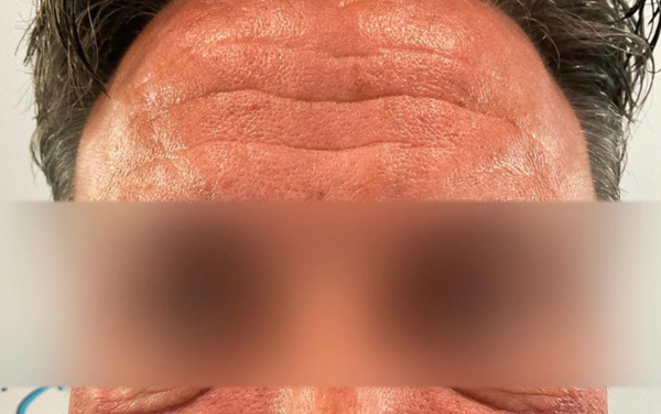 Morpheus8 skin tightening - Imagine a treatment that can magically restore your skin's youthful glow – that's Morpheus8! It stimulates collagen production deep within your skin, helping to smooth out wrinkles and fine lines for a more youthful appearance.
One of the great things about Morpheus8 is its versatility. It's suitable for most all skin types and can be used on various areas of the face and body, making it a versatile option for anyone looking to turn back the clock.
Morpheus8's non-invasive nature means minimal to no downtime or surgery required. It's a comfortable and safe way to rejuvenate your skin without the need for invasive procedures.
It's time to embrace the future of skincare and say goodbye to wrinkles – Morpheus8 is here to help you look and feel your best.
Book Your Appointment:
(310) 272-9988
https://drdoris.com
Beverly Hills Morpheus8 skin tightening - Imagine a treatment that can magically restore your skin's youthful glow – that's Morpheus8! It stimulates collagen production deep within your skin, helping to smooth out wrinkles and fine lines for a more youthful appearance.
One of the great things about Morpheus8 is its versatility. It's suitable for most all skin types and can be used on various areas of the face and body, making it a versatile option for anyone looking to turn back the clock.
Morpheus8's non-invasive nature means minimal to no downtime or surgery required. It's a comfortable and safe way to rejuvenate your skin without the need for invasive procedures.
It's time to embrace the future of skincare and say goodbye to wrinkles – Morpheus8 is here to help you look and feel your best.
Book Your Appointment:
(310) 272-9988
https://drdoris.com
Beverly Hills